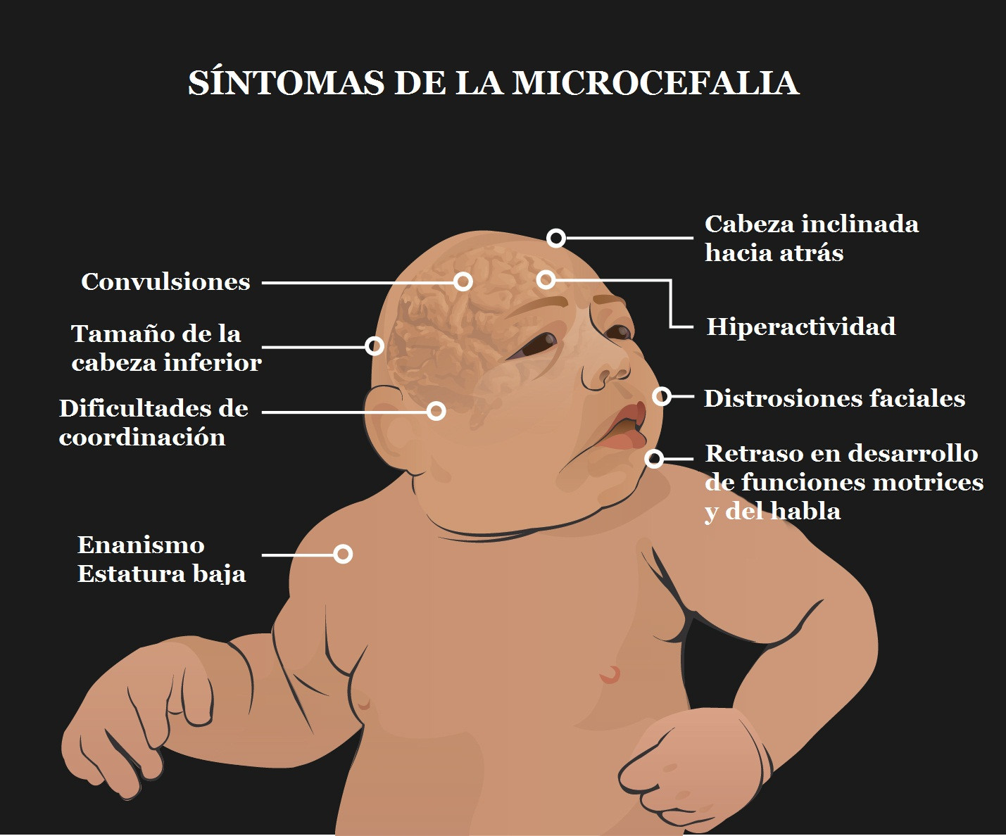 Microcefalia sintomascopia 1