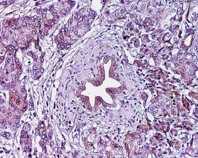 Cancer pancreas tne 1