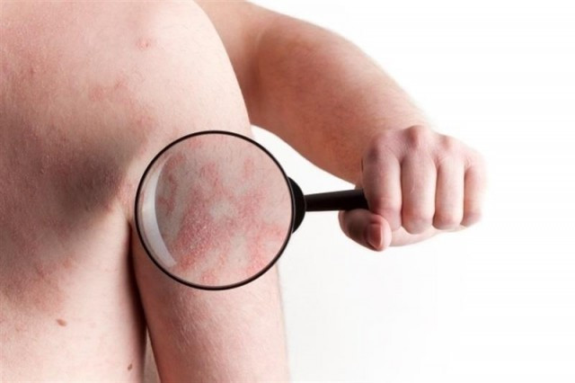 Psoriasis