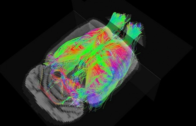 La ressonància magnètica detecta de forma precoç l'Alzheimer