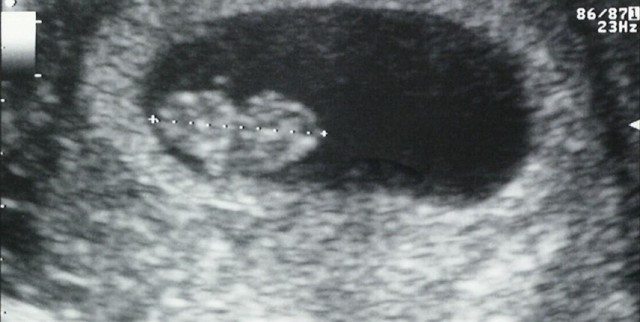 Aborto espontneo embarazo zika 11052018