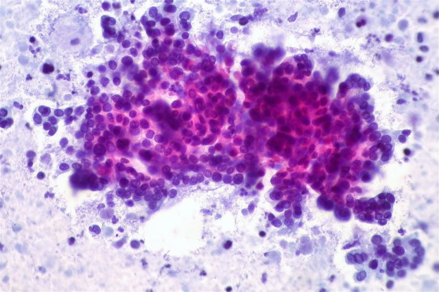 Anlisissangrecncer