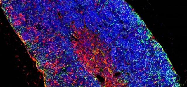 Descobreixen una nova diana terapèutica per a un tipus de leucèmia infantil