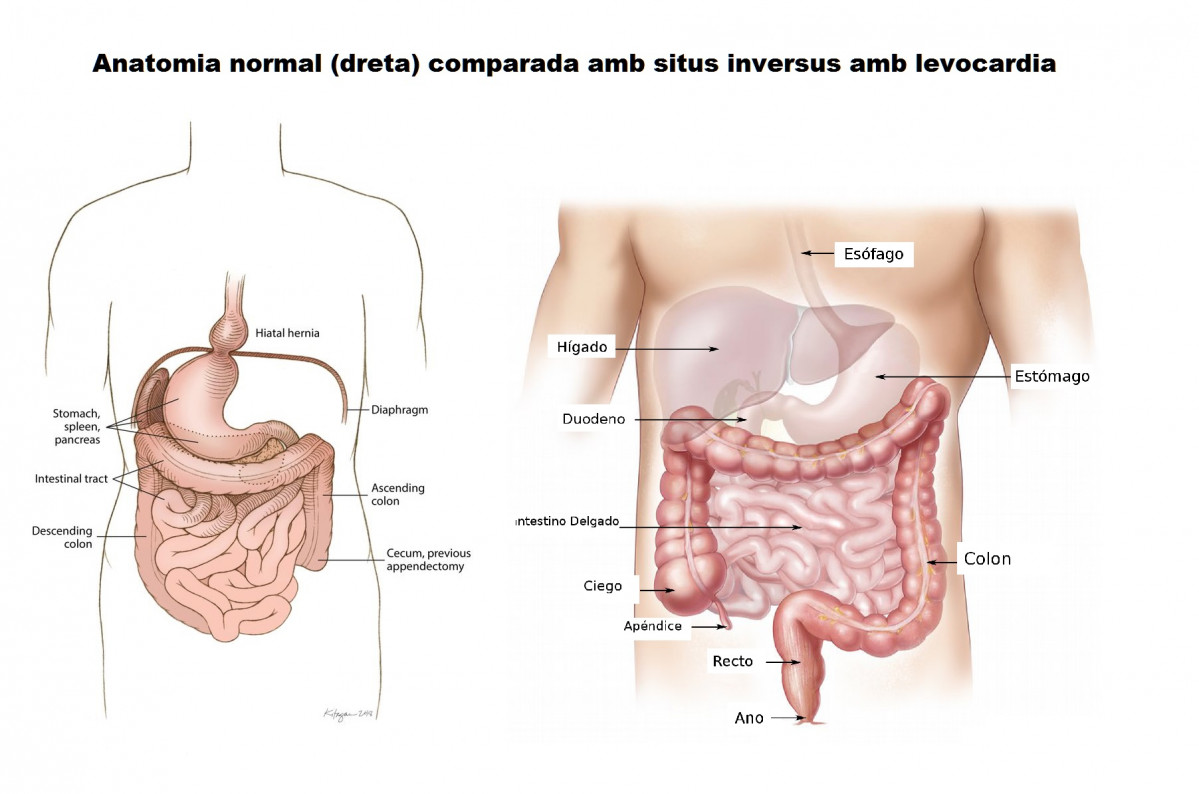 Anatomia normal dreta comparada amb situs inversus amb levocardia