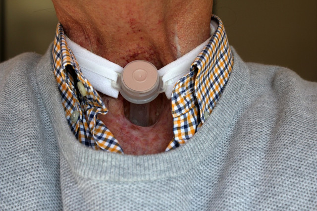 Laringectoma