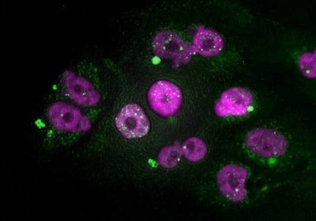Clulas tumorales de adenocarcinoma de pncreas