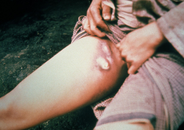 Plague buboes 1
