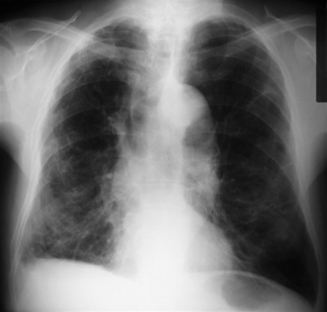 Pulmones 2