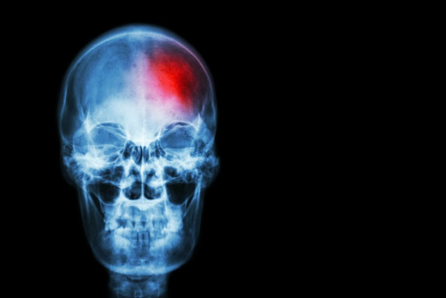 ​Descobreixen la manera com els ictus maten les neurones i obren la porta a tractaments més eficaços