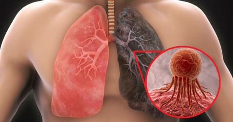 Visita de doctor cuales son las complicaciones que tiene el cancer de pulmon
