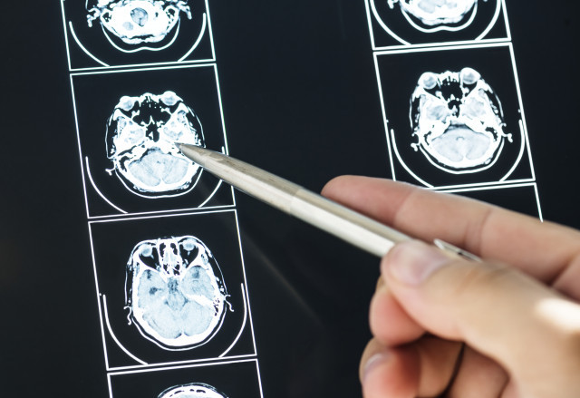 L'estudi que demostra el paper genètic en el risc de desenvolupar un ictus