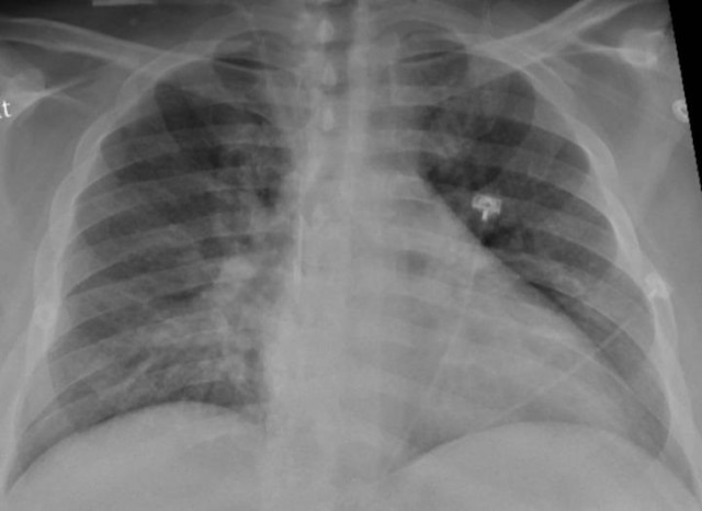 EuropaPress 3456789 radiografia torax paciente positivo covid 19 muestra neumonia parte