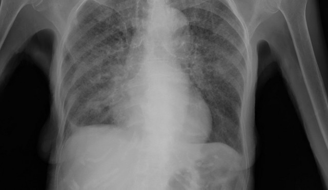 Troben una nova estratègia per aturar la metàstasi al càncer de pulmó