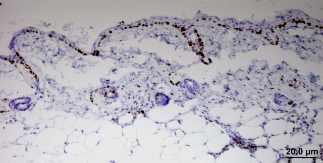 Catalunyapresscancer