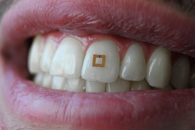 En l'última dècada s'han col·locat 17 milions d'implants dentals a Espanya