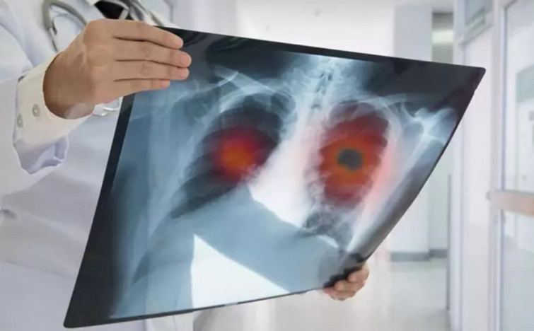 Per què s'estan disparant els casos de tuberculosi infantil a Europa?
