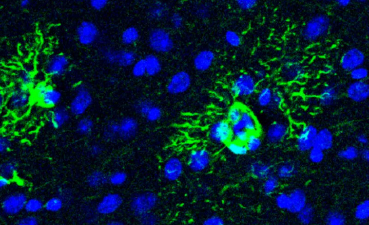 Descobreixen el possible origen ocult de l'Alzheimer: una proteïna clau podria anticipar la malaltia