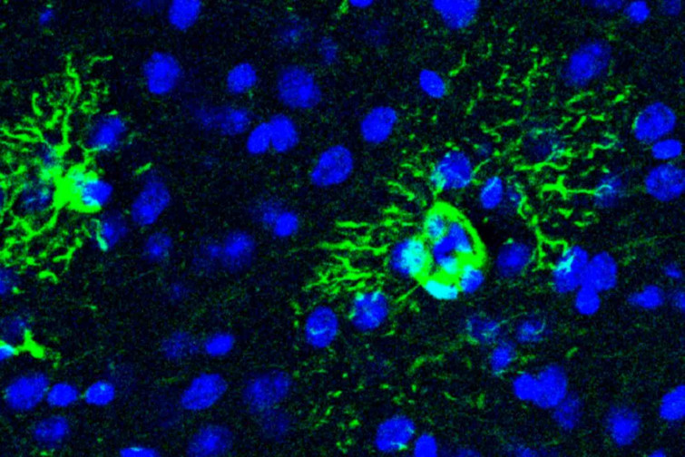 Descobreixen el possible origen ocult de l'Alzheimer: una proteïna clau podria anticipar la malaltia