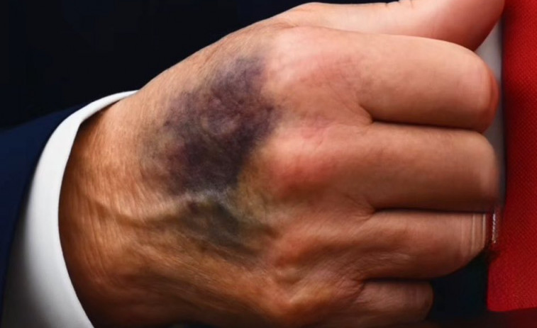 Els mitjans dels EUA investiguen la salut de Trump després de fotografies de les seves mans
