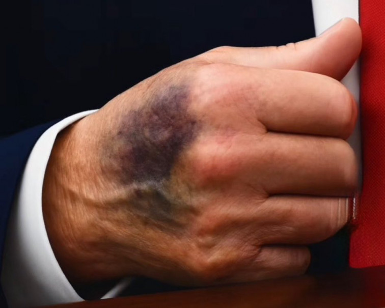 Els mitjans dels EUA investiguen la salut de Trump després de fotografies de les seves mans