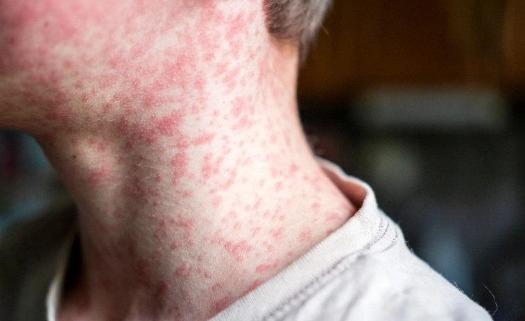 Un èxit dels antivacunes: la OMS retira a Espanya dels països lliures de xarampió