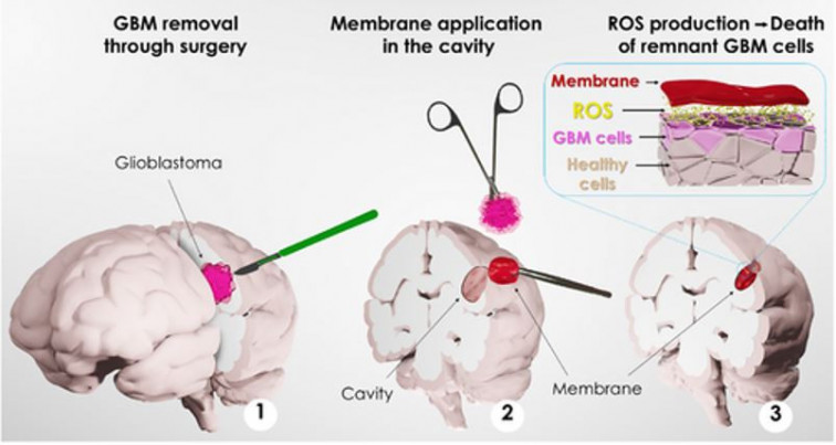 Científics de l'ICN2, la UAB i Bellvitge creen un pegat adhesiu per a tractar tumors cerebrals agressius