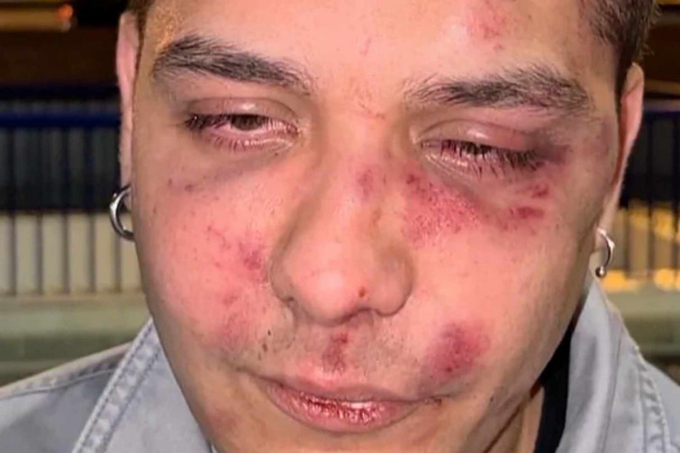 VÍDEO | Un jove denúncia que ha rebut una brutal pallissa a Màlaga: “Tu ets antifeixista, veritat?”