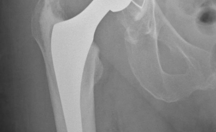 Les fractures de maluc eleven el risc de mortalitat en persones majors