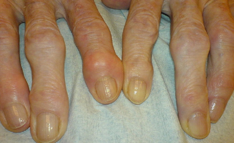 El fred no empitjora l'artrosi, però sí que pot augmentar el dolor i la rigidesa