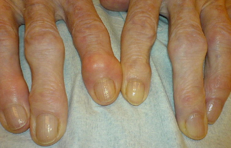 El fred no empitjora l'artrosi, però sí que pot augmentar el dolor i la rigidesa