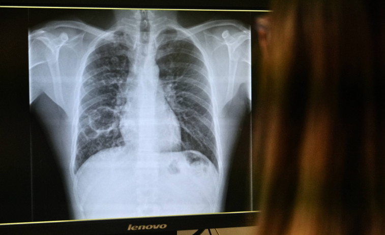 L'Hospital Joan XXIII de Tarragona reforça el dispositiu per a atendre la tuberculosi