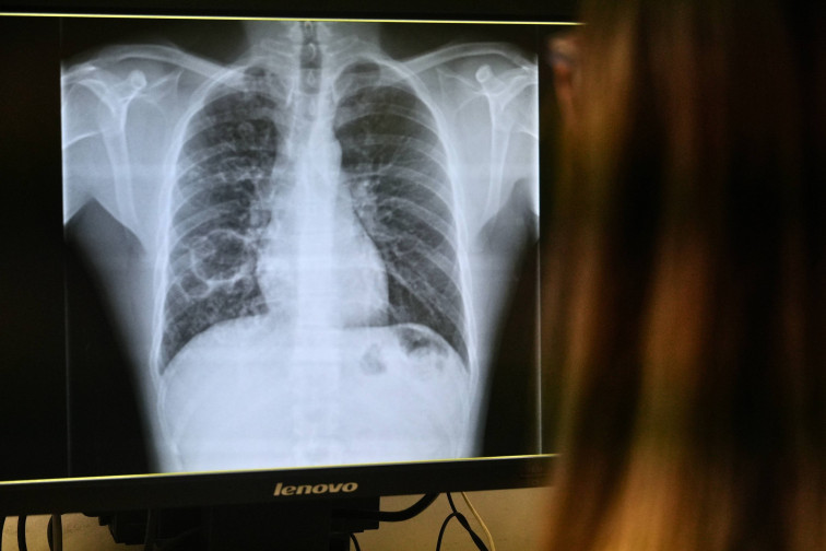 L'Hospital Joan XXIII de Tarragona reforça el dispositiu per a atendre la tuberculosi