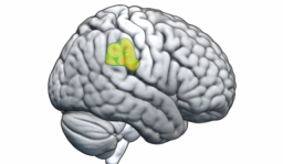 Un estudio del Sant Joan de Déu revela cambios cerebrales clave en la lentitud del Parkinson
