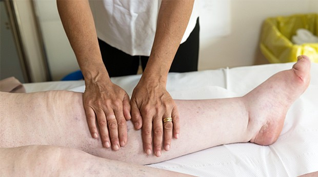 Lymphedema 1