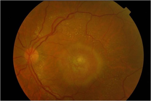 retina ep