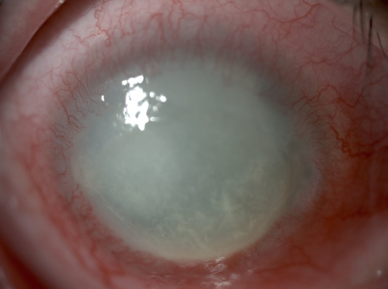 Queratitis per Acanthamoeba