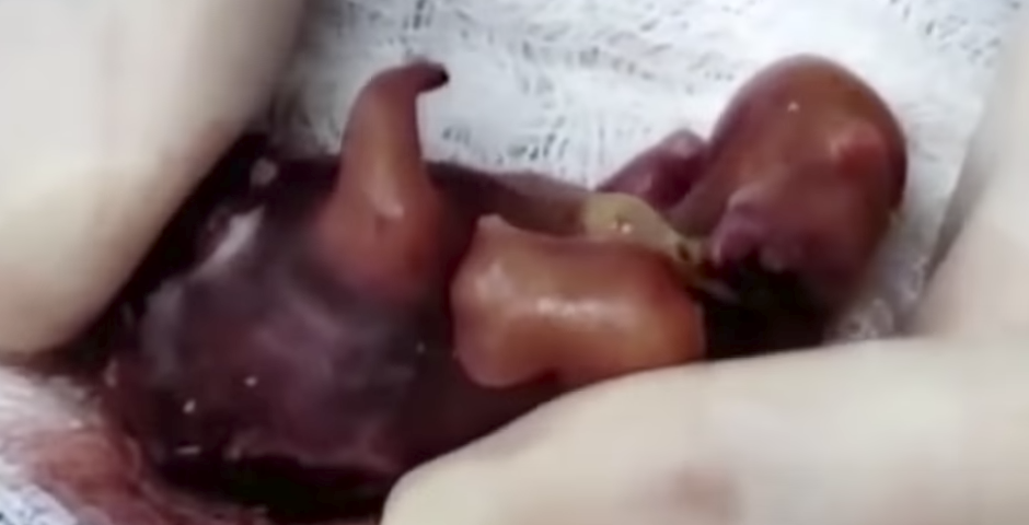 El fetus que van extreure de la bebu00e9 Itzamara