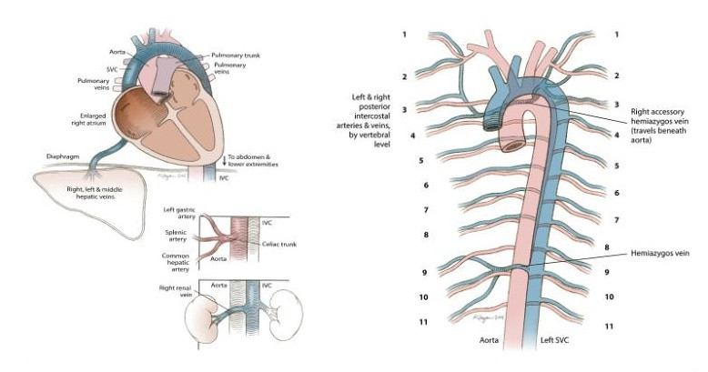 La vena cava aberrant de Rose Marie Bentley