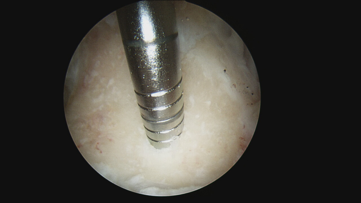 Subcondroplastia