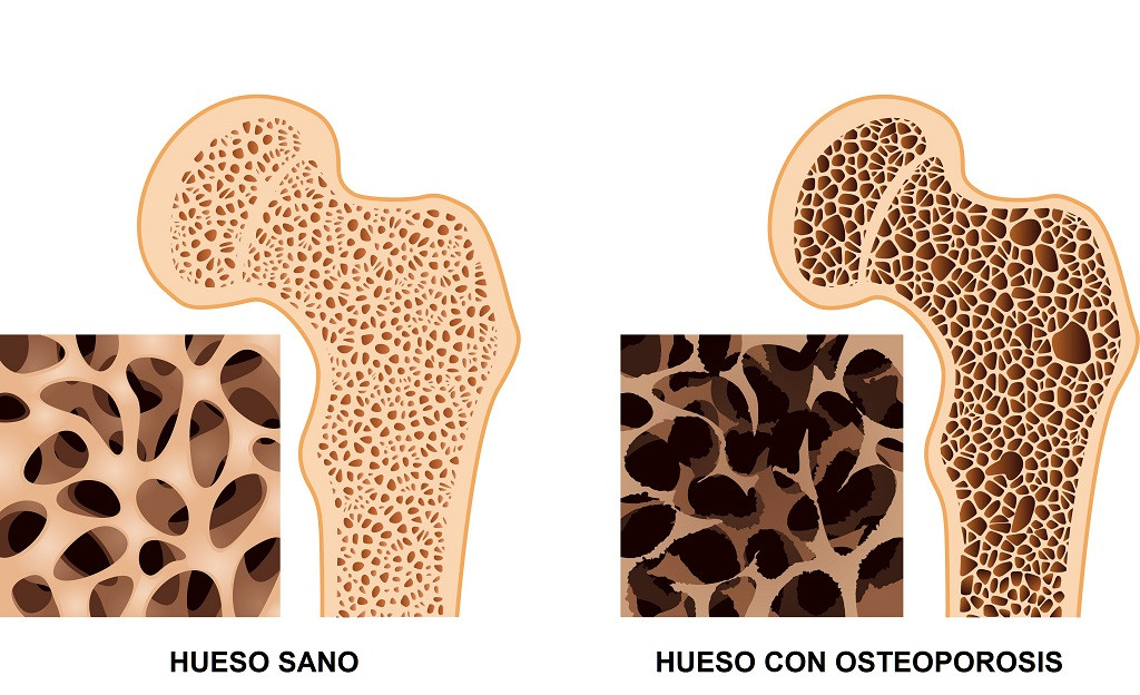 osteoporosi