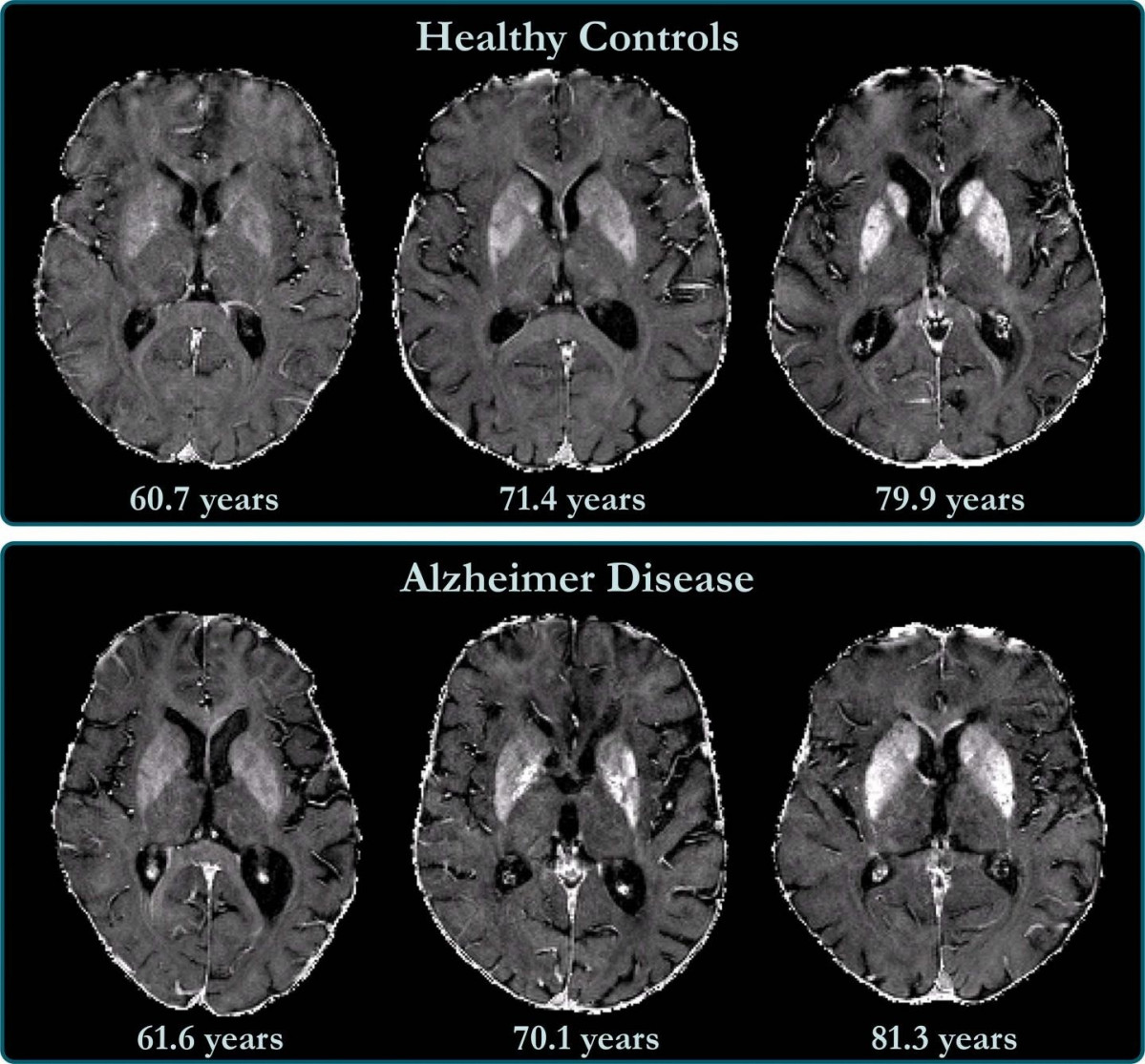 L'acumulació de ferro al cervell està relacionada amb el deteriorament cognitiu en pacients amb Alzheimer.