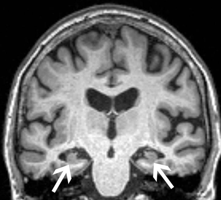 Ressonància magnètica de el cervell d'una dona de 72 anys mostra la pèrdua de volum de l'hipocamp (fletxes). La pacient tenia les tres característiques: pèrdua de volum de l'hipocamp, APOE4, i ansietat.