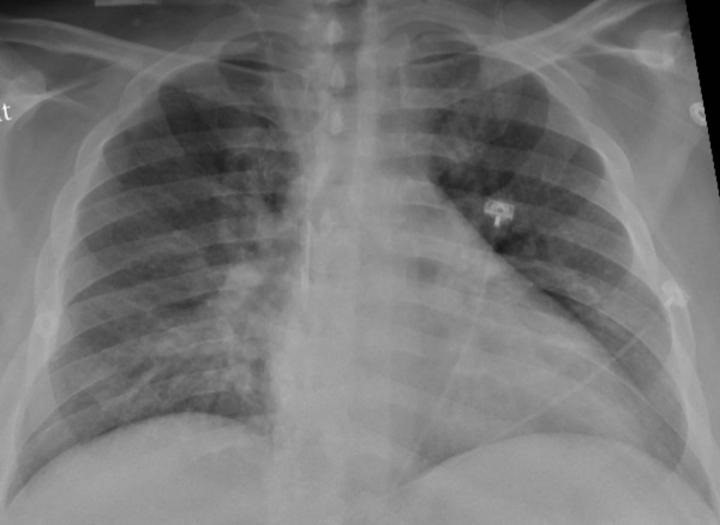 La radiografia de tòrax d'un pacient positiu de COVID-19 que mostra una pneumònia a la part inferior dels pulmons.