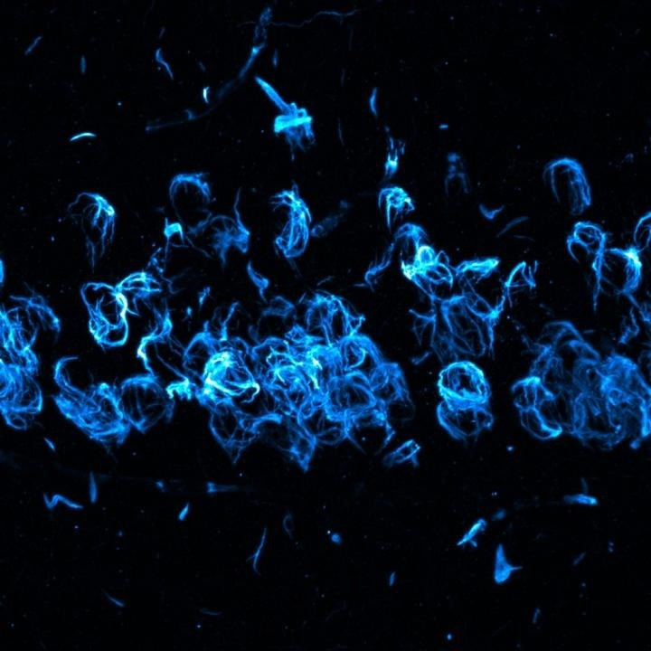 Arxiu - Un estudi genètic confirma el vincle entre la demència dels cossos de Lewy, Alzheimer i Parkinson