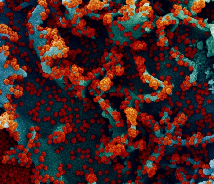 Micrografia electrònica d'escombrada acolorida d'una cèl·lula infectada amb SARS-CoV-2.