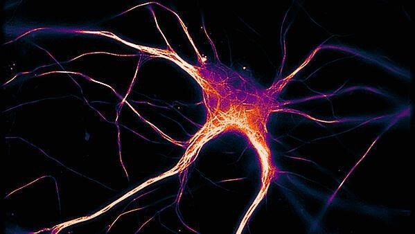 Arxiu - Una cèl·lula cerebral funcional que expressa tau malalta pròpia de l'Alzheimer.