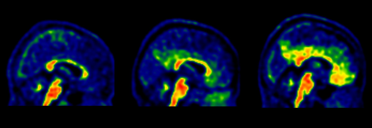 Identifiquen nous valors associats a l'Alzheimer que permetran ampliar la prevenció