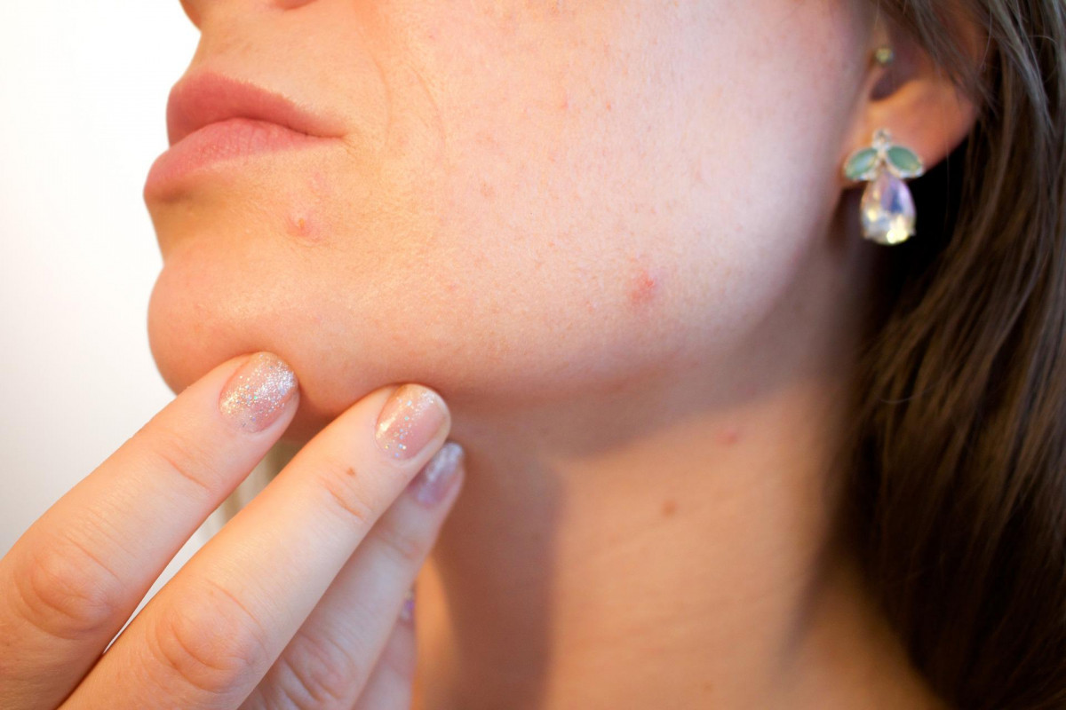 Acne gd4e28bb3e 1920