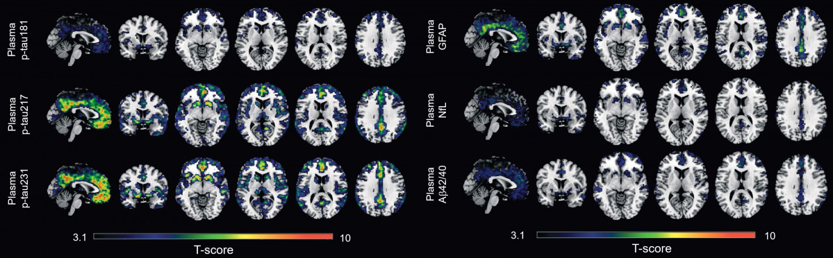 Un estudi identifica dos biomarcadors a la sang per captar els primers indicis de l'Alzheimer