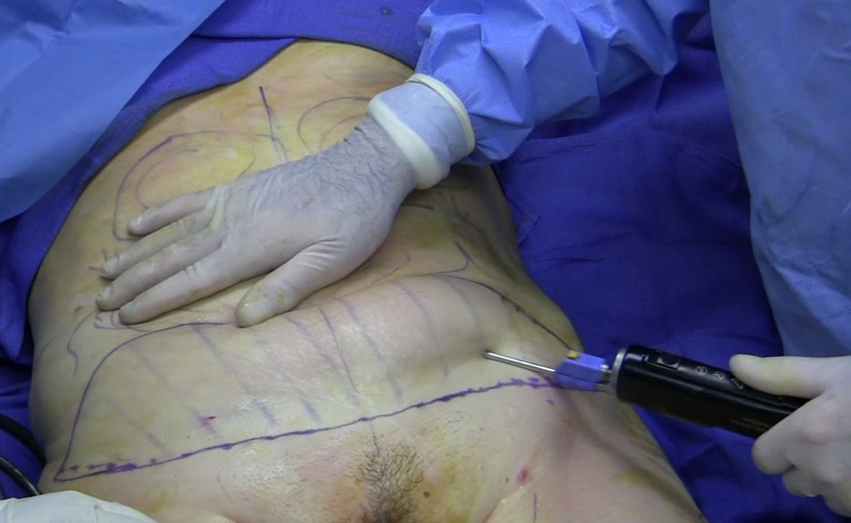 Fat removal using cannula during tumescent liposuction (1)